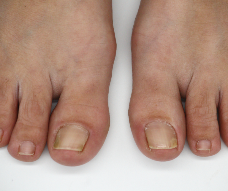 Nexus 2.9 Toenails BG