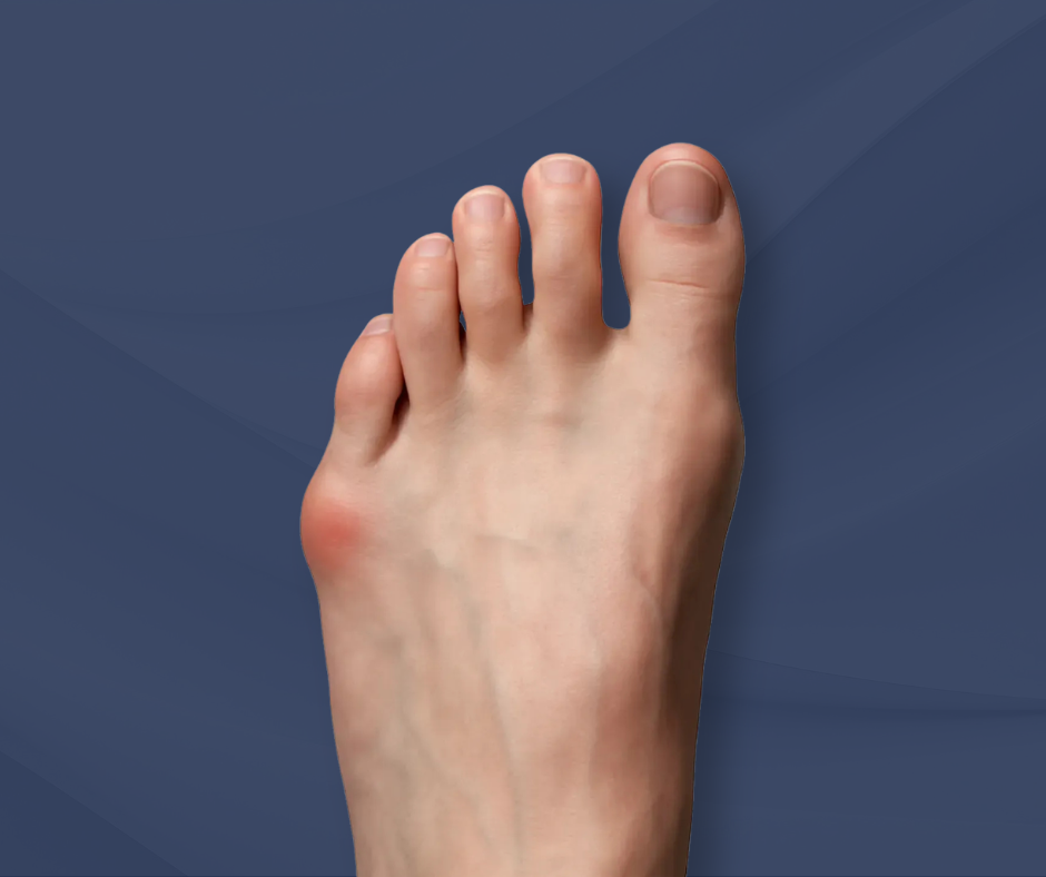 What That Bump on Your Pinky Toe Really Means 1 bunionette