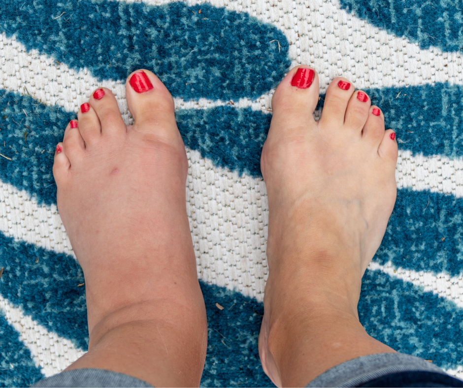 Why Foot Edema Can Be Dangerous 1 swollen foot