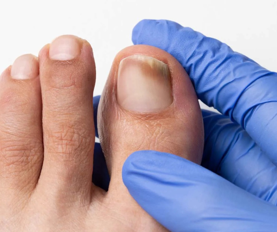 What Happens If You Ignore a Toenail Fungus Infection? 1 foot with toenail fungus