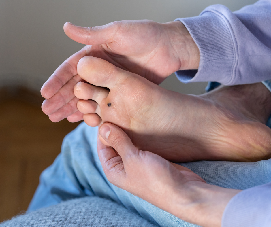 plantar wart on foot