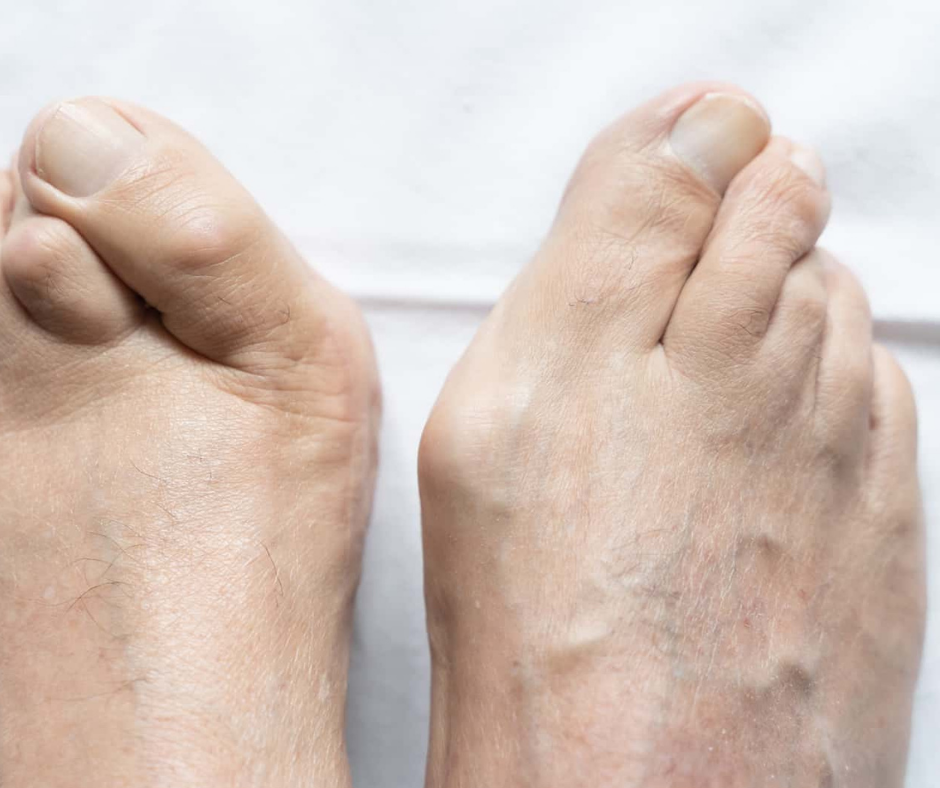 Can Hammertoes Be Corrected Without Surgery? 1 foot with hammertoe