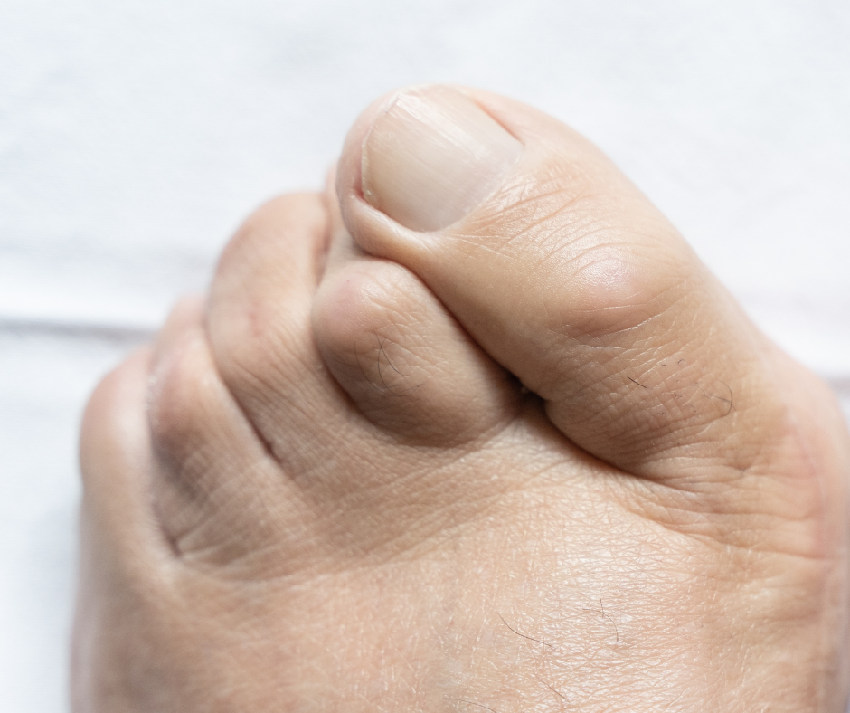When a Toe Starts Crossing Over Its Neighbor 1 foot with crossed toes